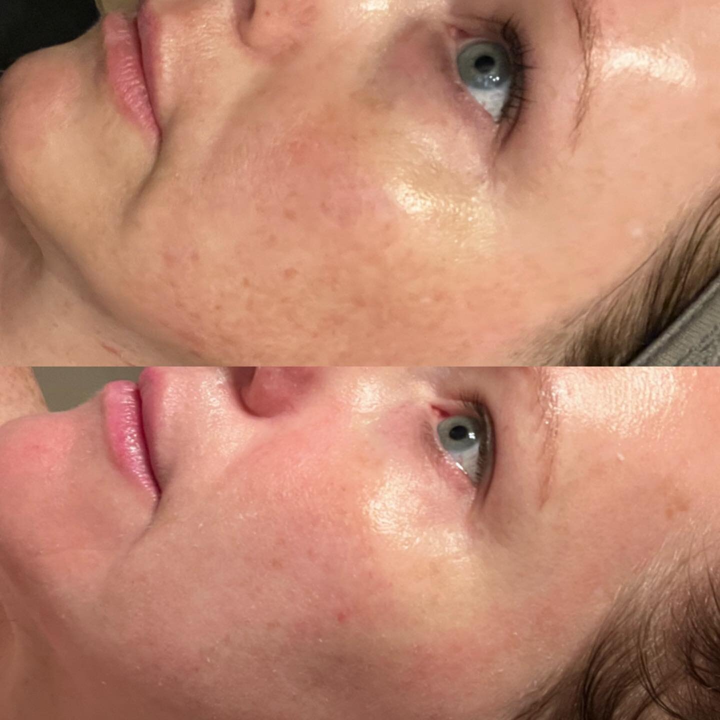 My personal progress results after doing a series of 3 #microneedling treatments and one gentle #rhondaallison peel over the course of 3 months. Plus a daily skincare regimen to correct, prevent, and protect the skin. 🙌🏼

I always recommend coming 