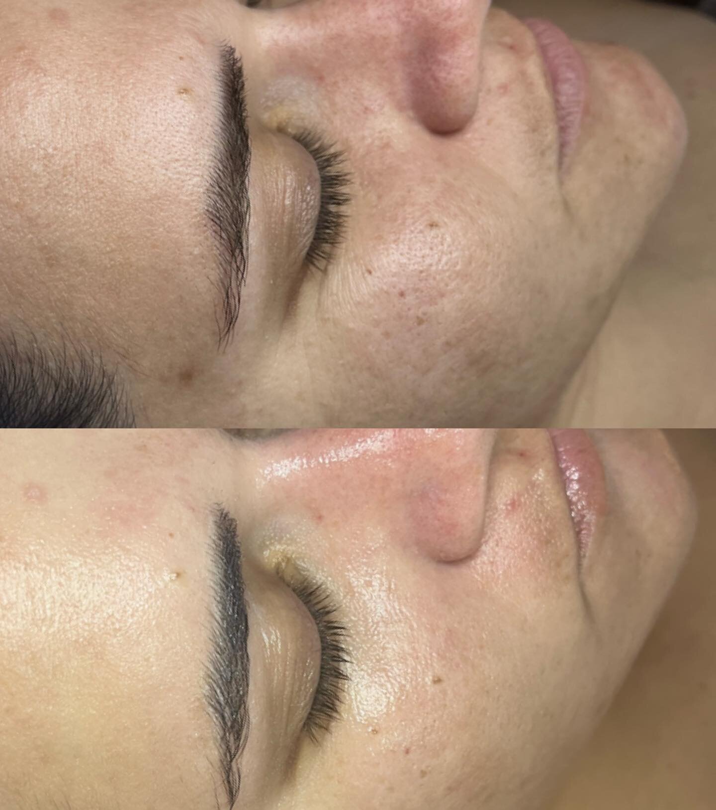#hydrafacials are clinically-proven to improve skin concerns and give an instant glow. ✨ 

All clients receive $25 off their first HydraFacial! 🖤

Easy online booking 💻 

926-209-4050 ☎️