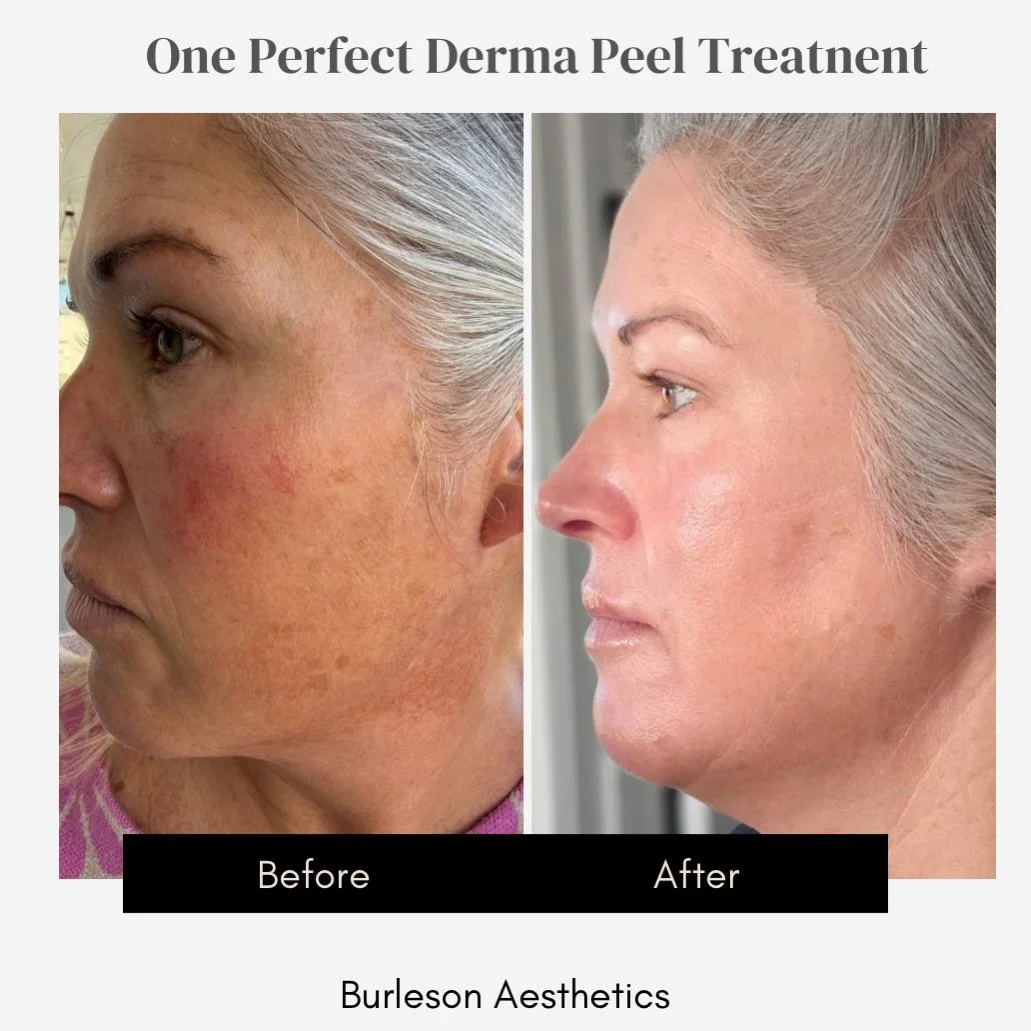 The Perfect Derma Peel did its job.
This client peeled for just 4 days and look at the transformation:

✔️ Texture dramatically smoother
✔️ Pigmentation lifted
✔️ Fine lines softened
✔️ Redness calmed
✔️ Overall glow + skin health improved

Her skin 