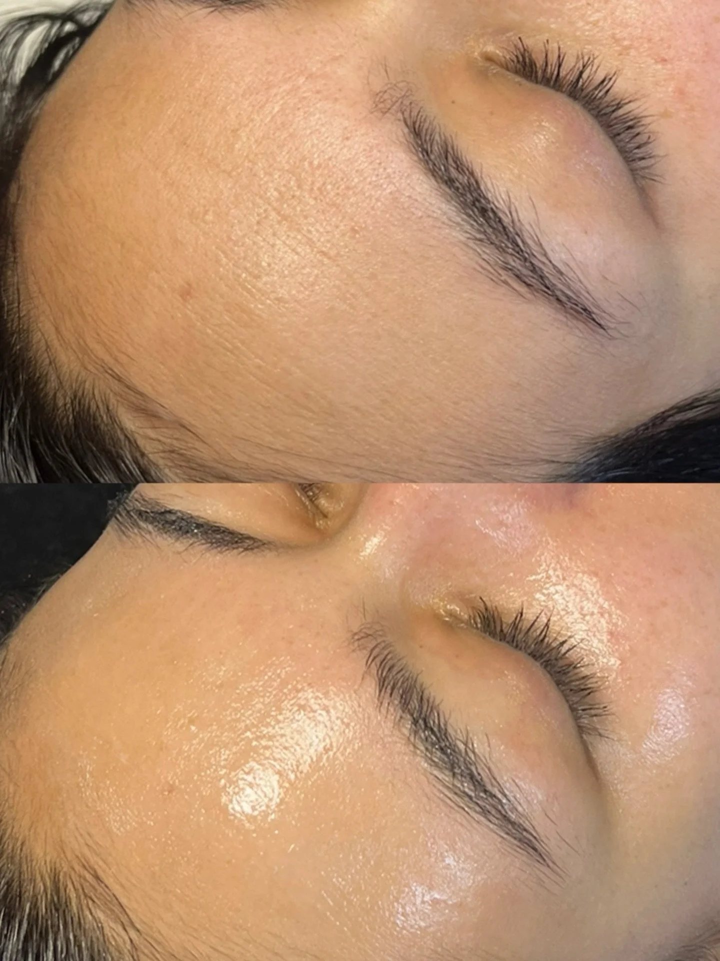 Dehydration + lack of exfoliation = fine lines that look deeper than they really are.
When dead skin builds up and the skin is thirsty, texture becomes more noticeable and lines appear etched in.

✨ HydraFacial deeply exfoliates, infuses hydration, a