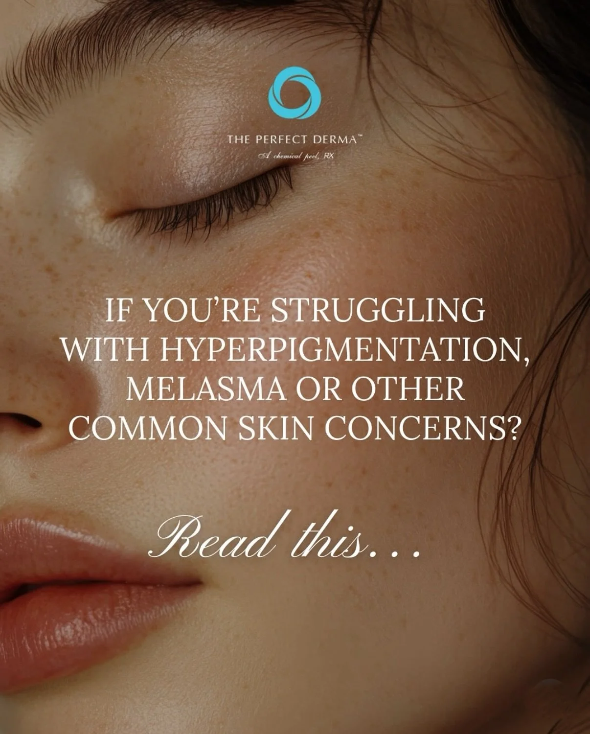 Hyperpigmentation acting up again?
Melasma refusing to mind its business?
Texture reminding you who&rsquo;s boss?

The Perfect Derma Peel is the reset button your skin has been begging for.
It&rsquo;s one peel.
One week.
A whole new level of glow. ✨
