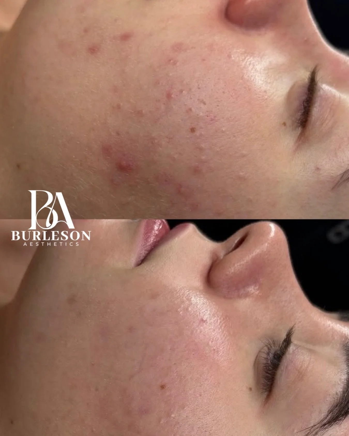 This client came in feeling frustrated and overwhelmed by her skin. She was using random products that weren&rsquo;t supporting her barrier or encouraging healthy turnover.

We simplified her routine and switched just a few key products to strengthen