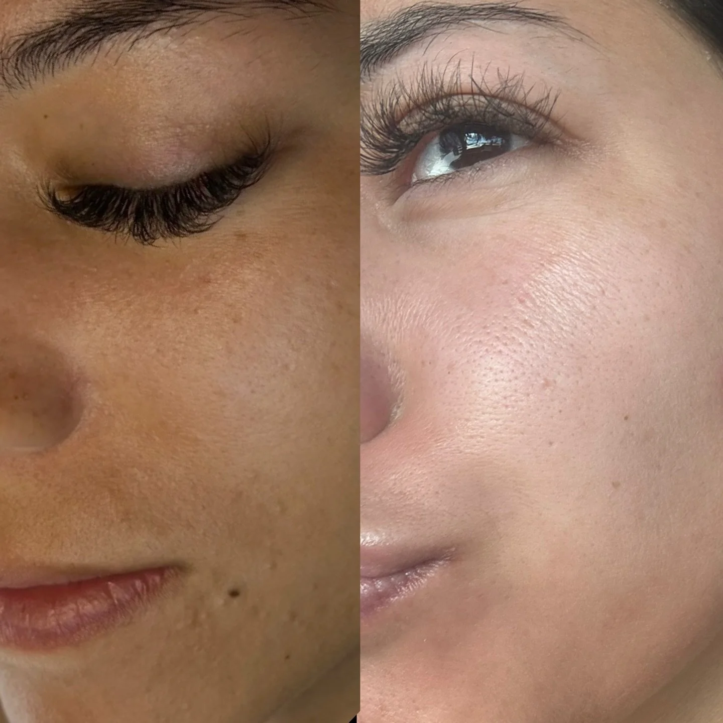 ✨ Results after just ONE Derma Peel ✨

This is day 7 and her skin is still healing, strengthening, and improving. 🤍

Even after one treatment, we&rsquo;re already seeing:
&bull; Smoother, more refined texture
&bull; Reduced congestion
&bull; Brighte