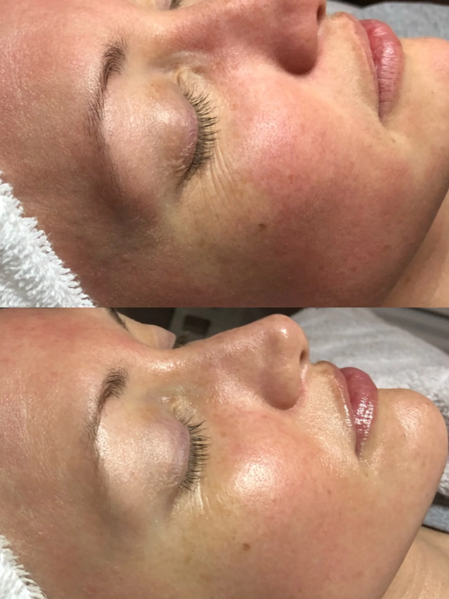 Green Renewal Facial 🌿 
Limited special through April. 💚

Dull, rough, congested skin usually isn&rsquo;t just buildup, it&rsquo;s a barrier that isn&rsquo;t functioning properly.

This is exactly what we corrected here.

We started with a gentle d