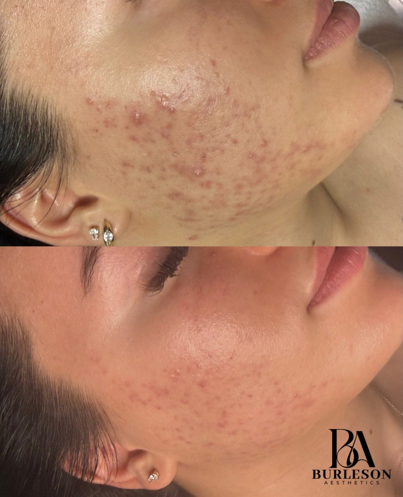 This transformation is after just ONE Perfect Derma Peel + ONE corrective VIP facial.

We focused on calming inflammation, resurfacing texture, and supporting the skin so it can heal and function the way it&rsquo;s supposed to.

But here&rsquo;s the 