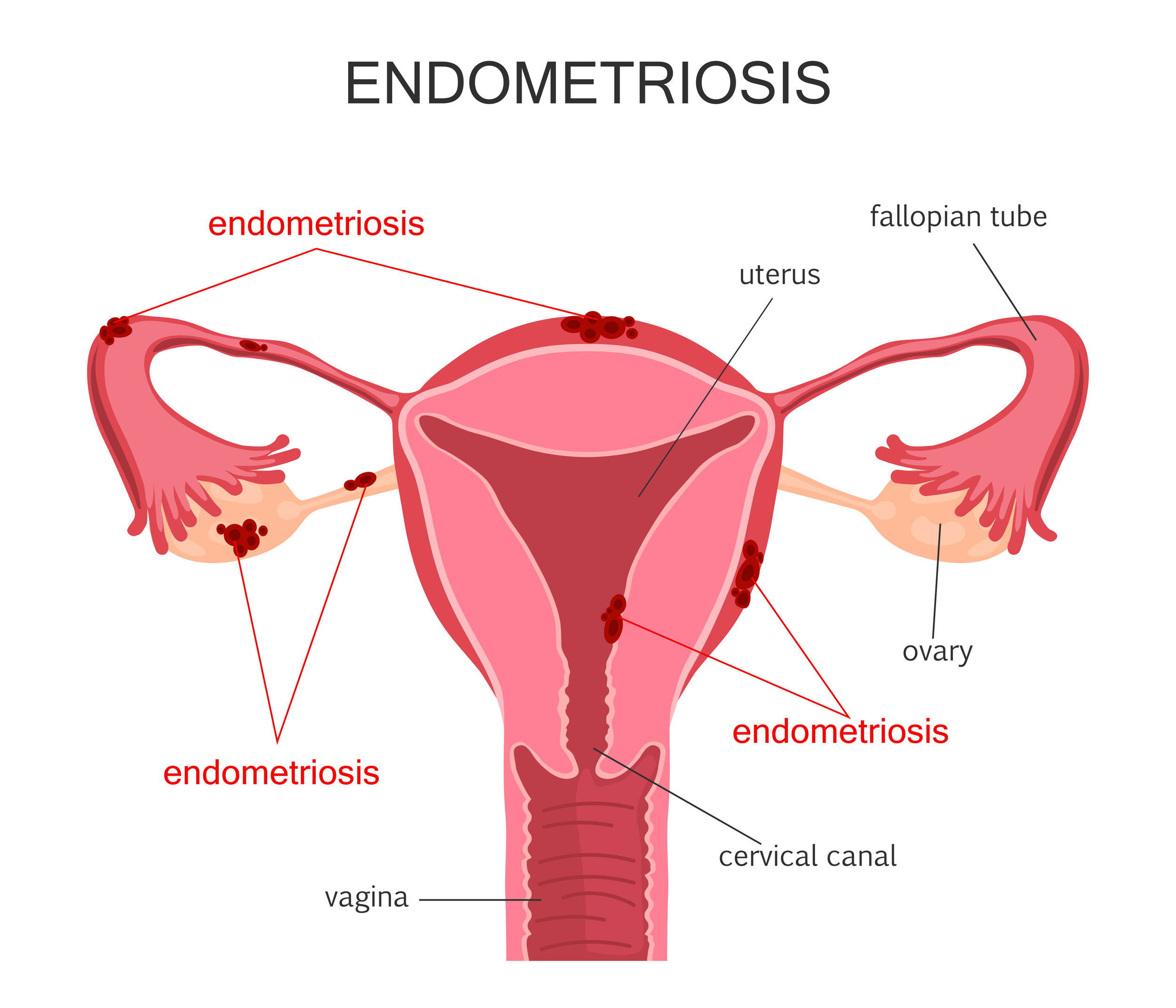 Endometriosis: Symptoms, causes and home remedies to manage pelvic pain, heavy  bleeding in women