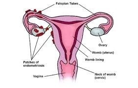 Endometriosis Stages Stages I - IV Explained A/Prof Alex Ades