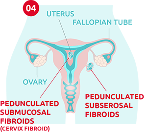 Types Of Fibroids 4 Types Of Fibroids Explained A Prof Alex Ades
