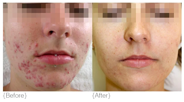 Acne_BeforeAfter_01.jpg