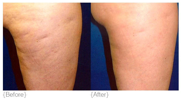 Cellulite_BeforeAfter_01.jpg