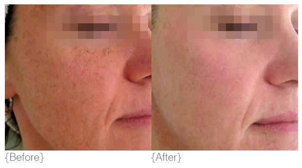 Pigmentation_BeforeAfter_01.jpg