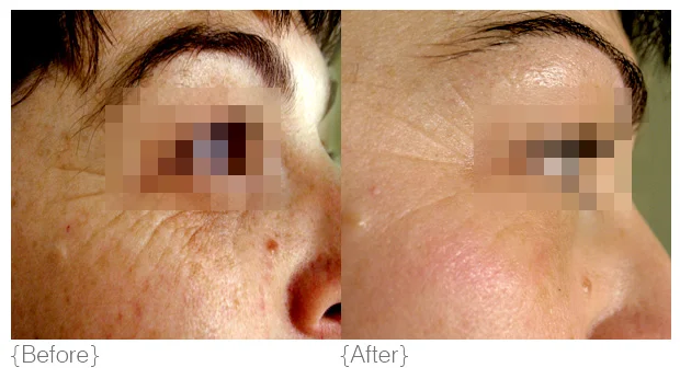 Wrinkles_BeforeAfter_01.jpg