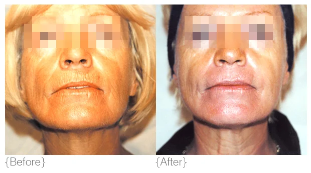 SunDamage_BeforeAfter_01.jpg