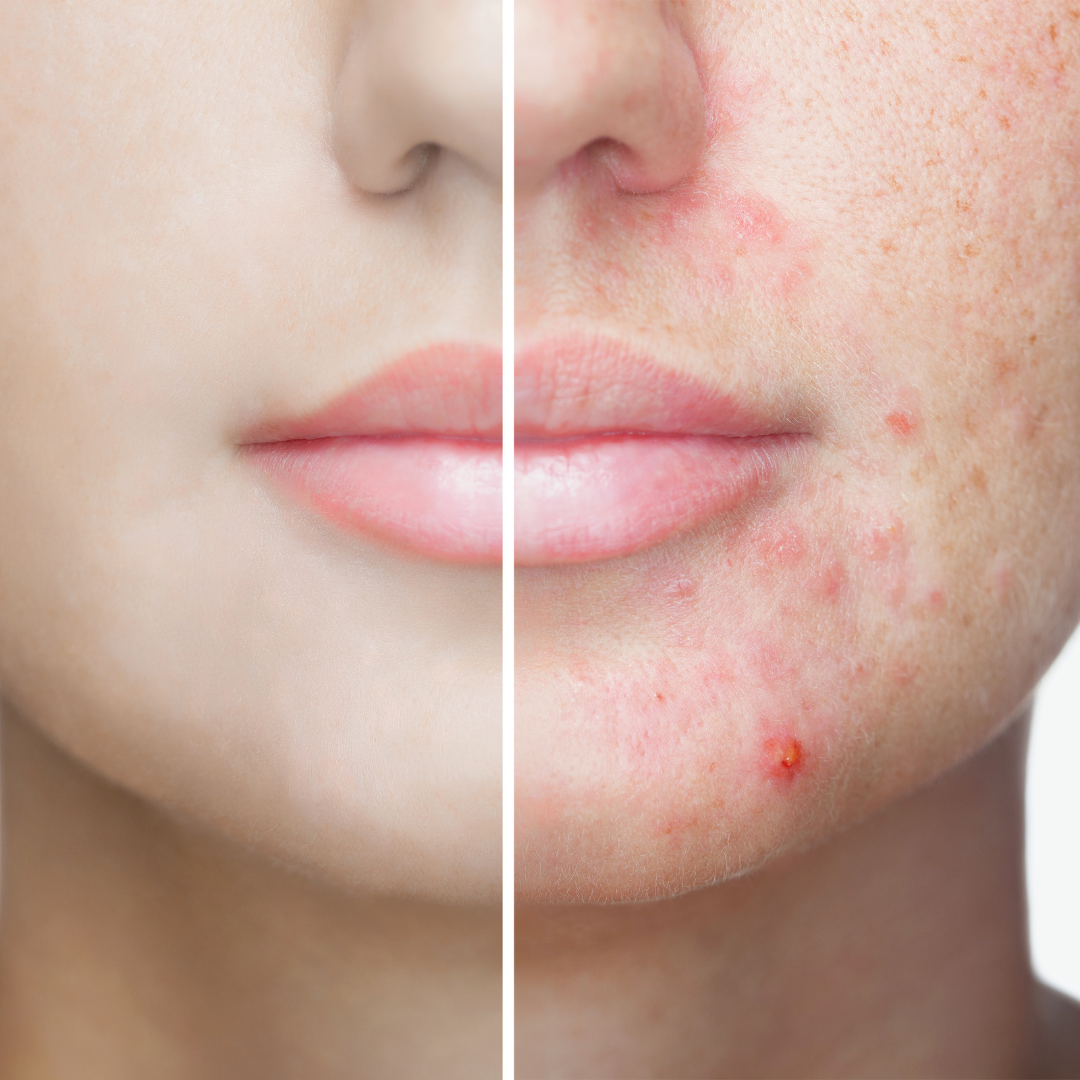 HOW TO GET RID OF ACNE
