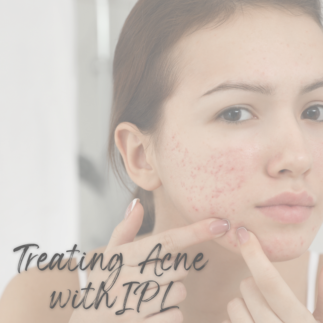 Treating Acne With IPL