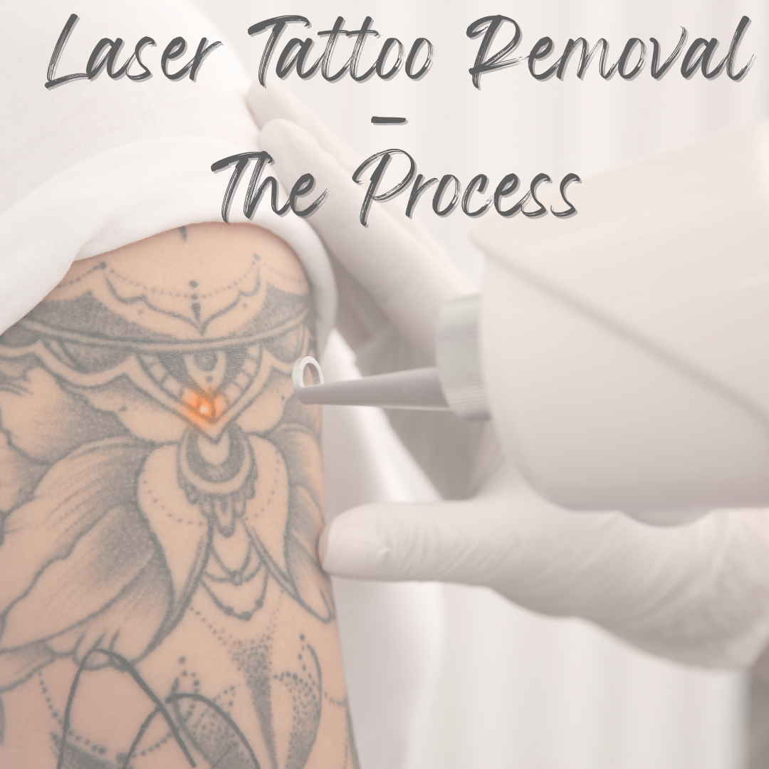 The Process Of Laser Tattoo Removal