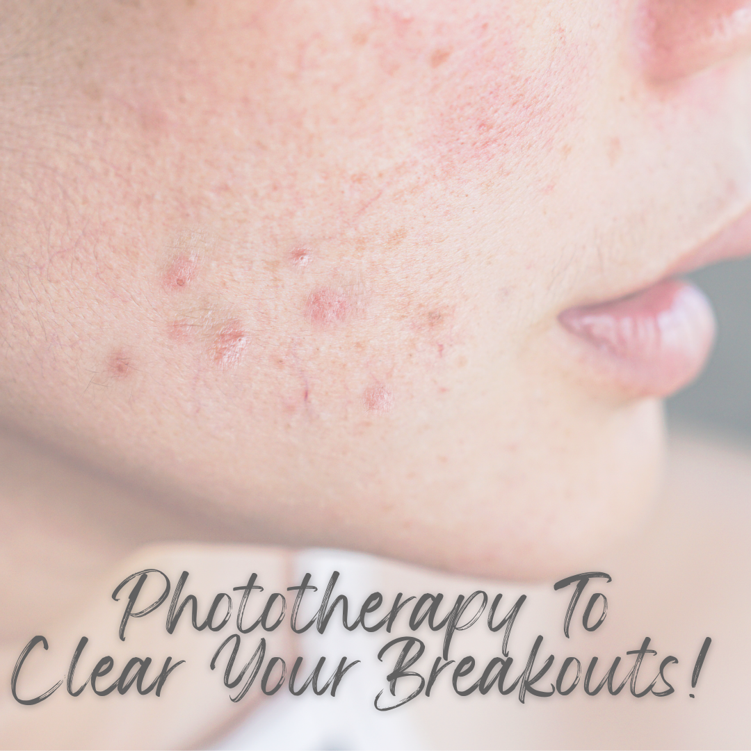 How Can Phototherapy Help With Your Acne?