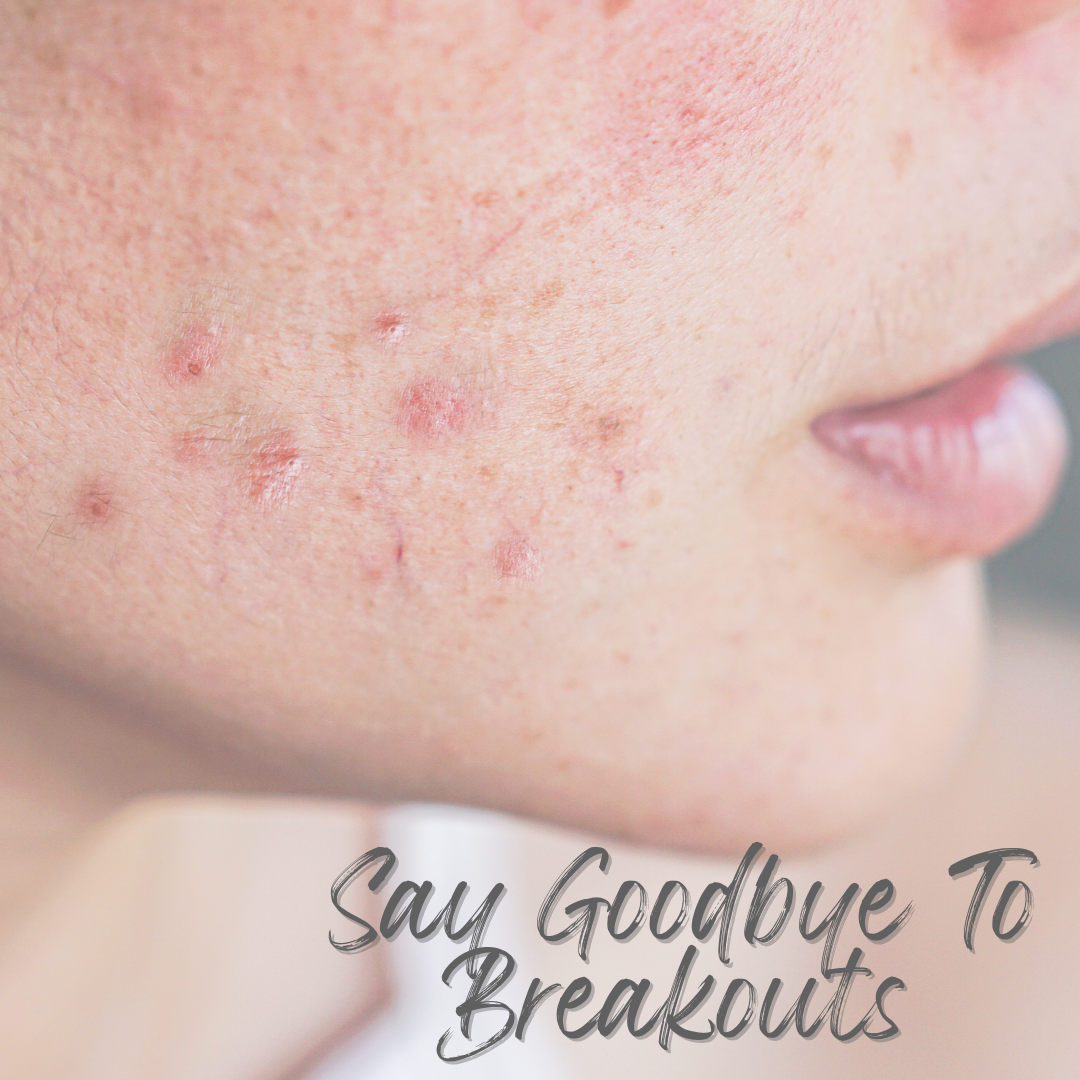 How To Clear Your Breakout-Prone Skin From Within