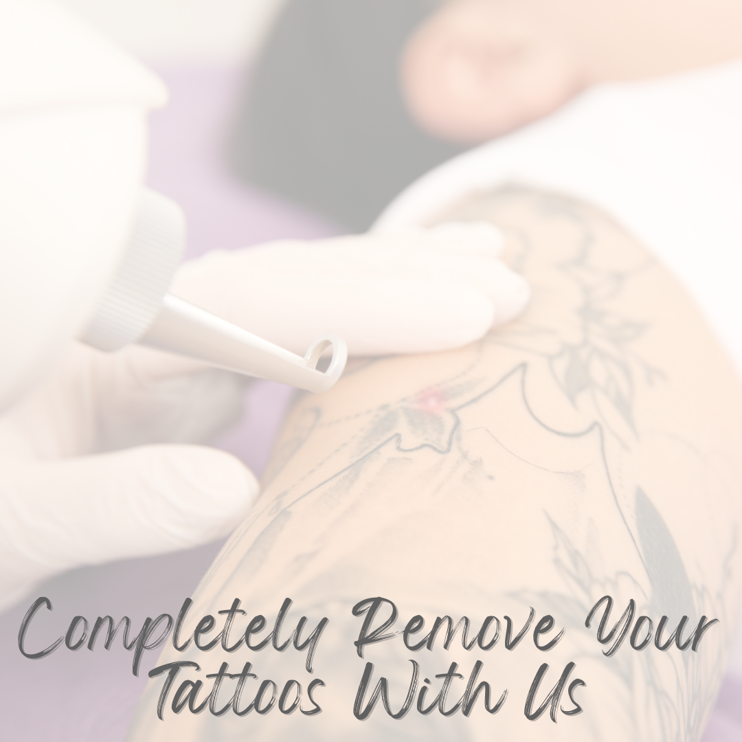 Will Tattoo Removal Completely Remove Your Tattoo?