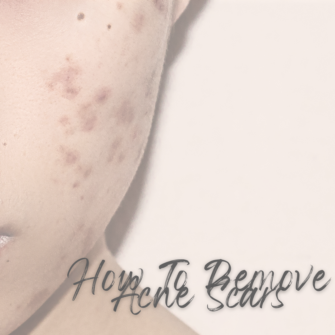 How Can I Remove My Acne Scars?