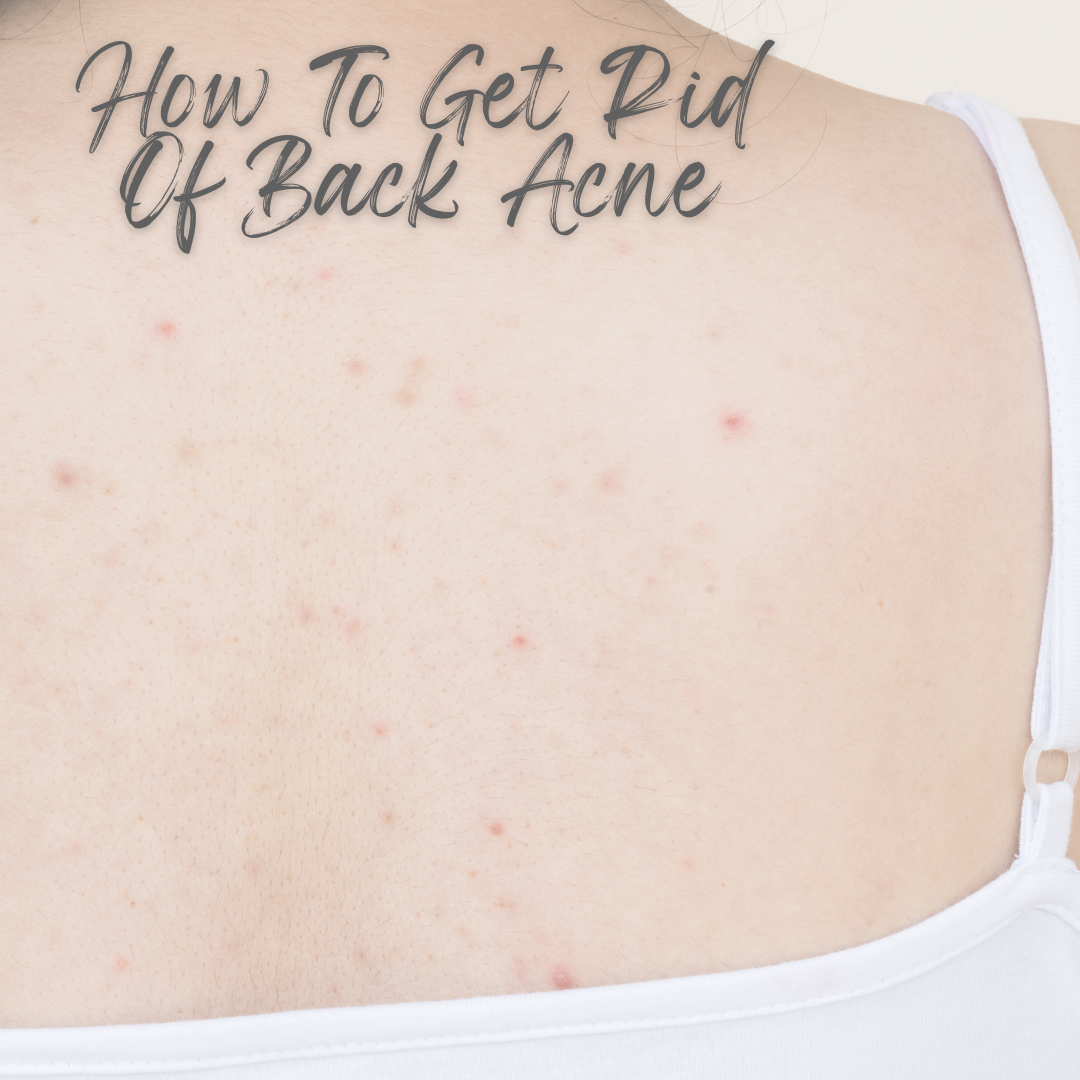 How Can I Get Rid Of Back Acne?