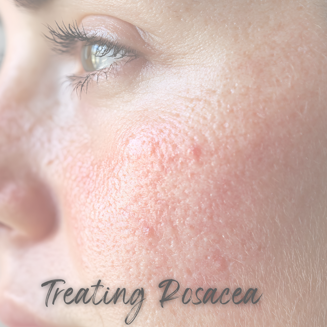What Causes Rosacea?
