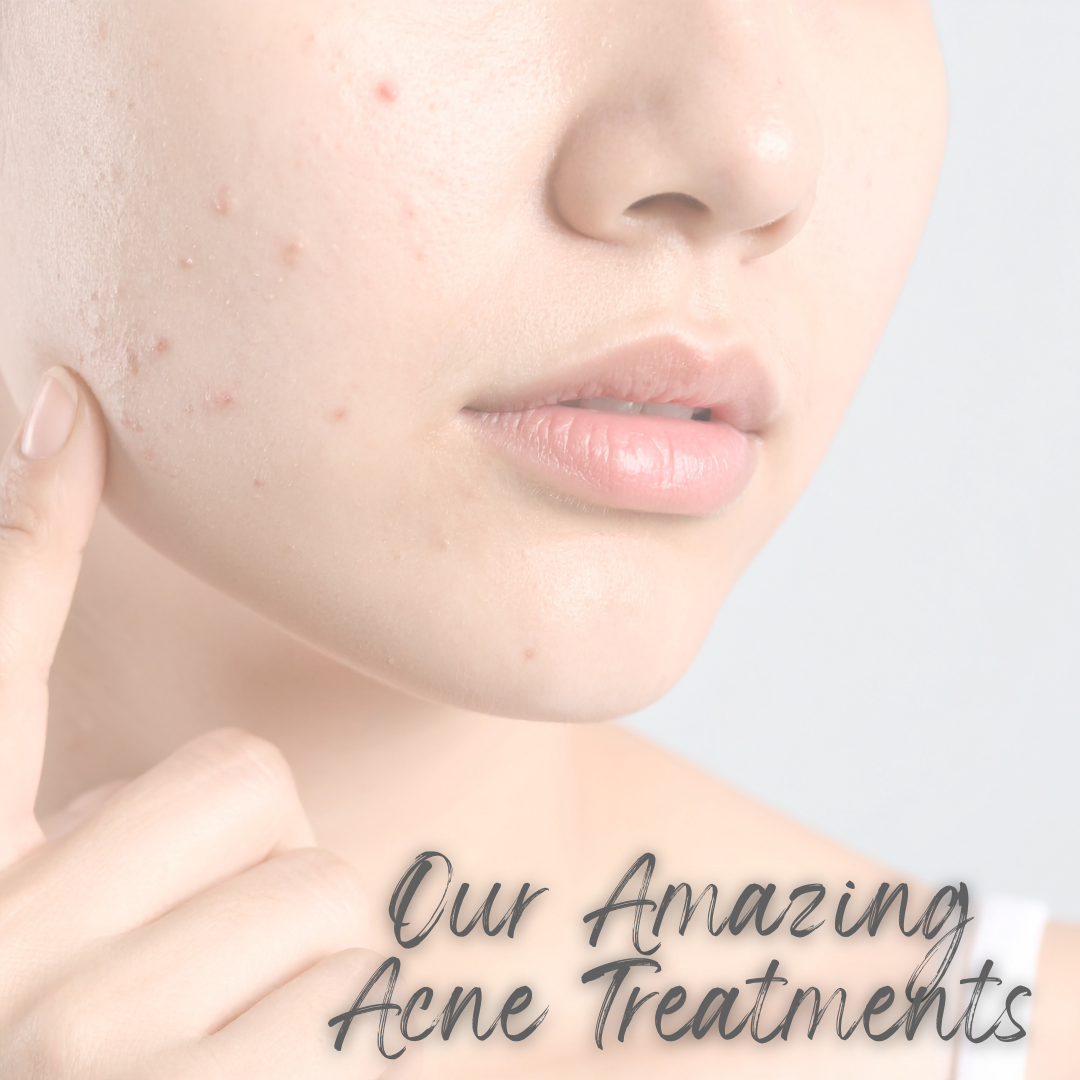 How Do I Choose The Best Acne Treatment For My Skin Type?
