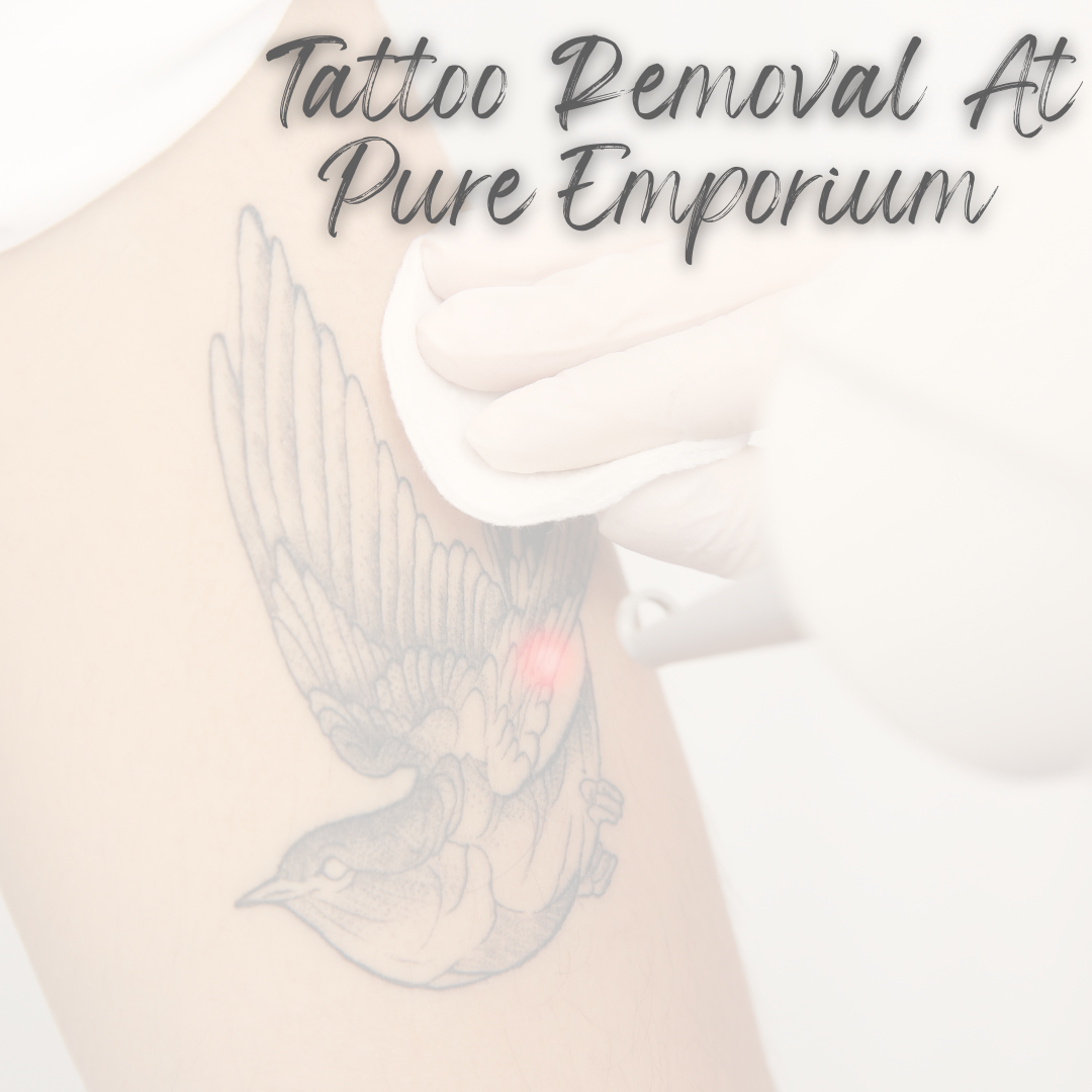 Everything You Need To Know Before Starting Laser Tattoo Removal