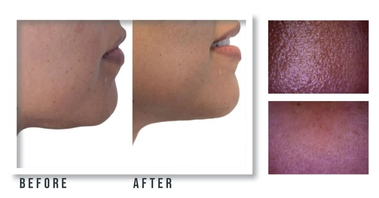 CACI RejuvaMed Before and After 2