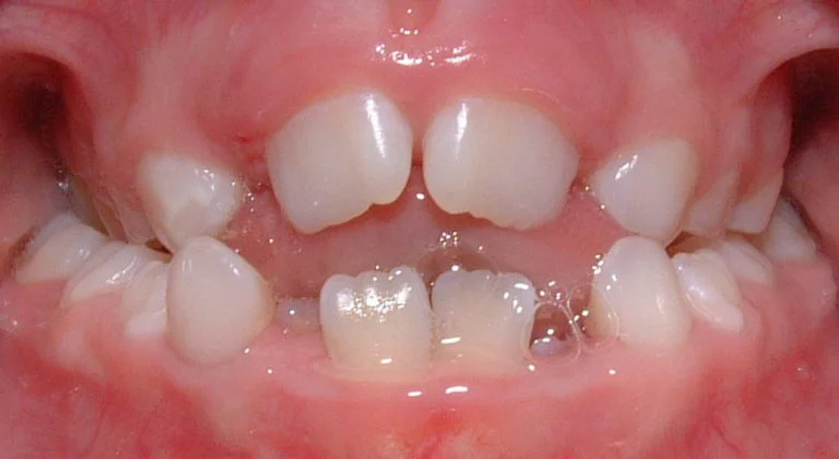 Open-Bite-768x420.jpg