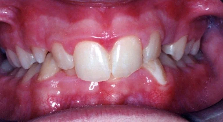 DeepBite-768x422.jpg