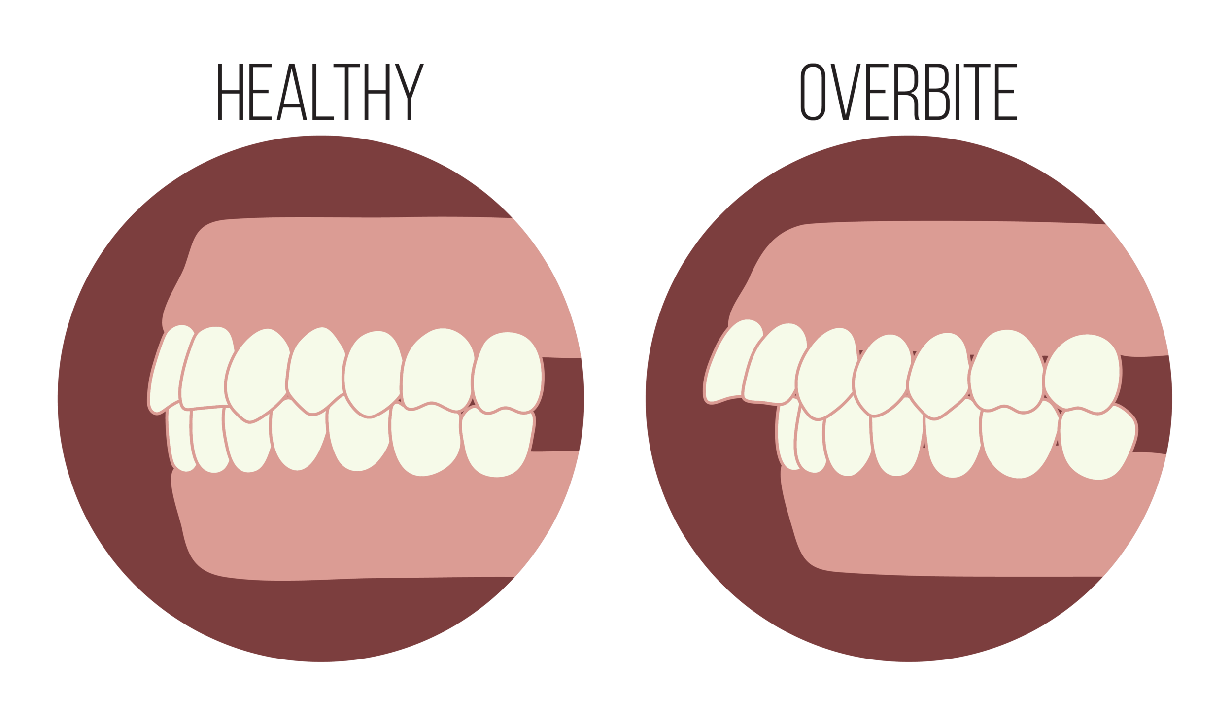 What Is an Overbite and How Can Braces Help?