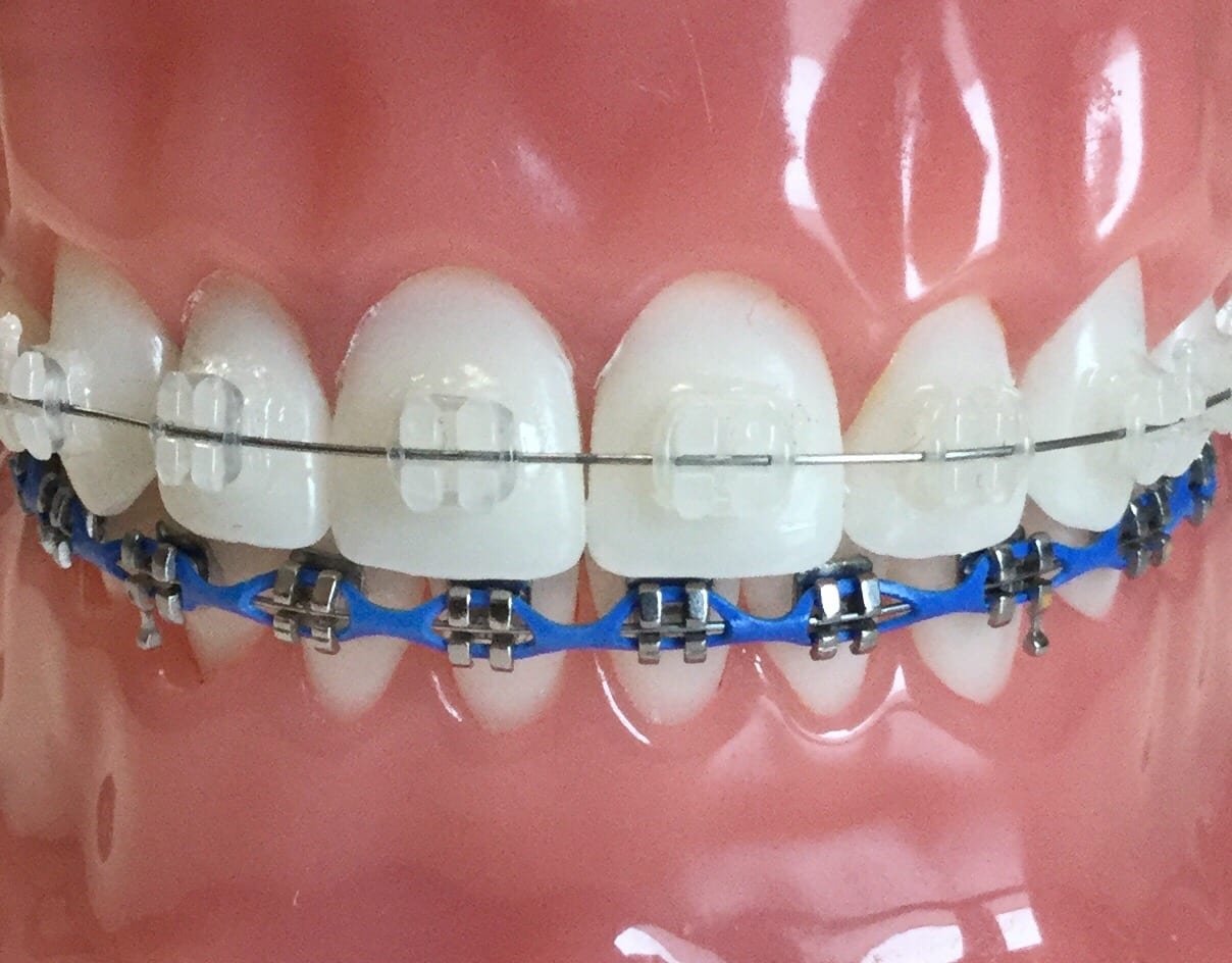 Ceramic Braces vs. Metal Braces - Sherman & Balhoff Orthodontics