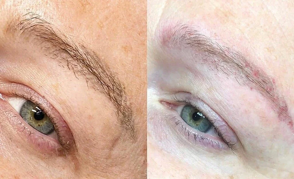 LiFT Tattoo Removal Before & Afters — Skin Studio OKC