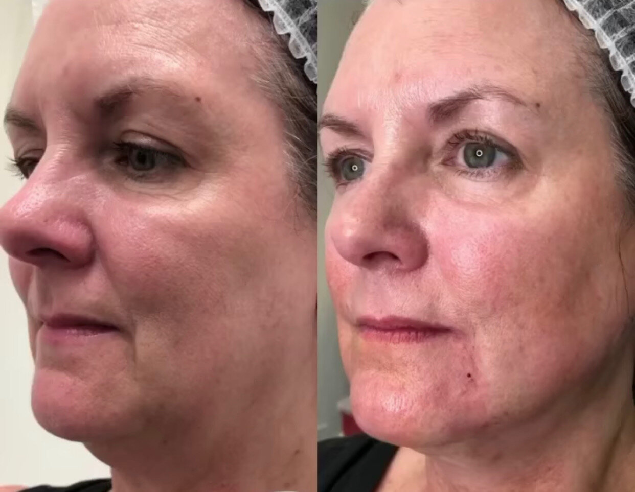 PDO Novathreads Before & Afters — Skin Studio OKC