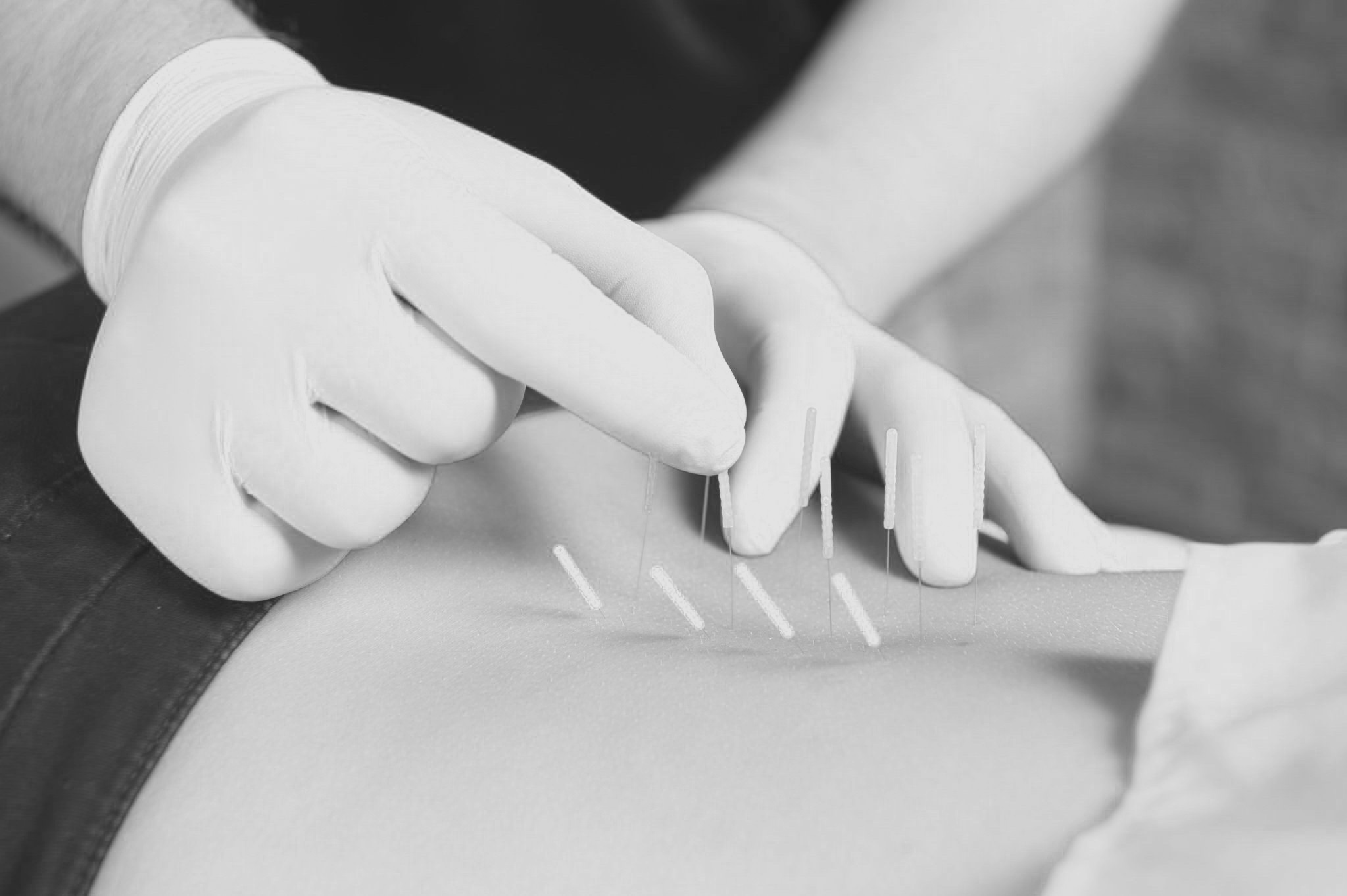 dry-needling.jpg