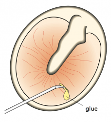 grommet 1.png