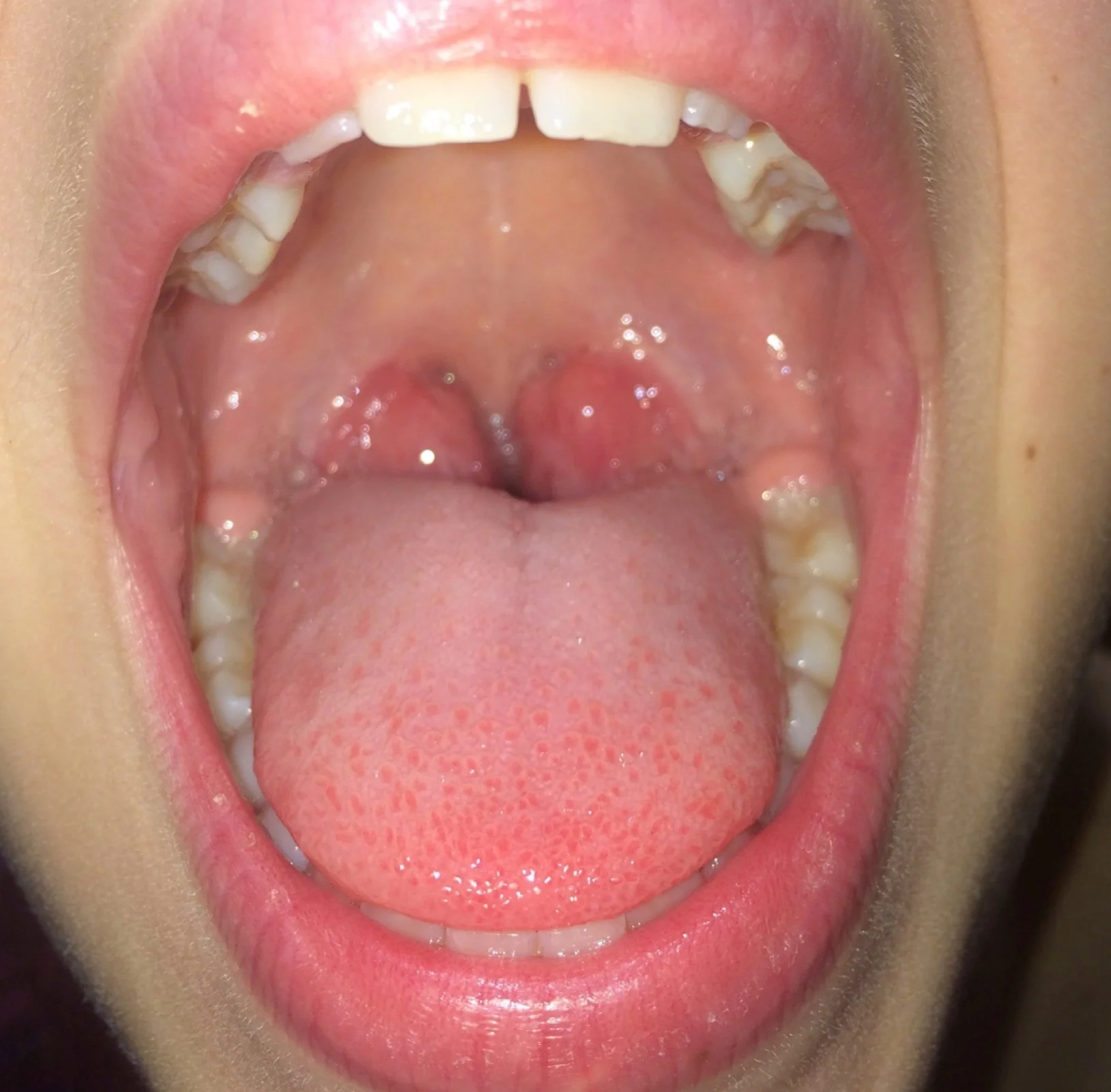 Acute+tonsillitis.jpg