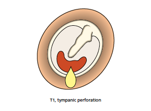 tympanic membrane perforation repair