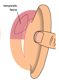 postaural approach.png