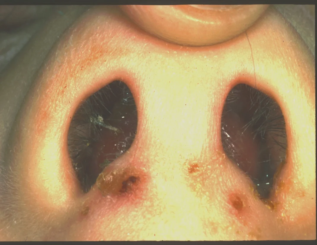 septal+haematoma.jpg