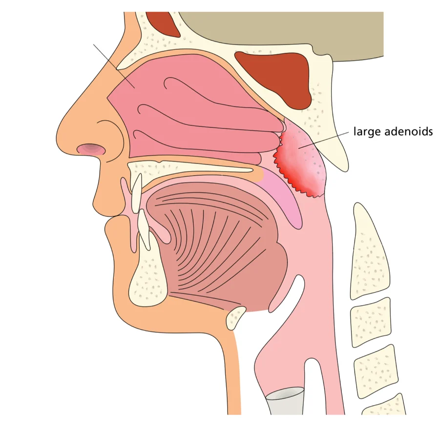large adenoids 2.jpg