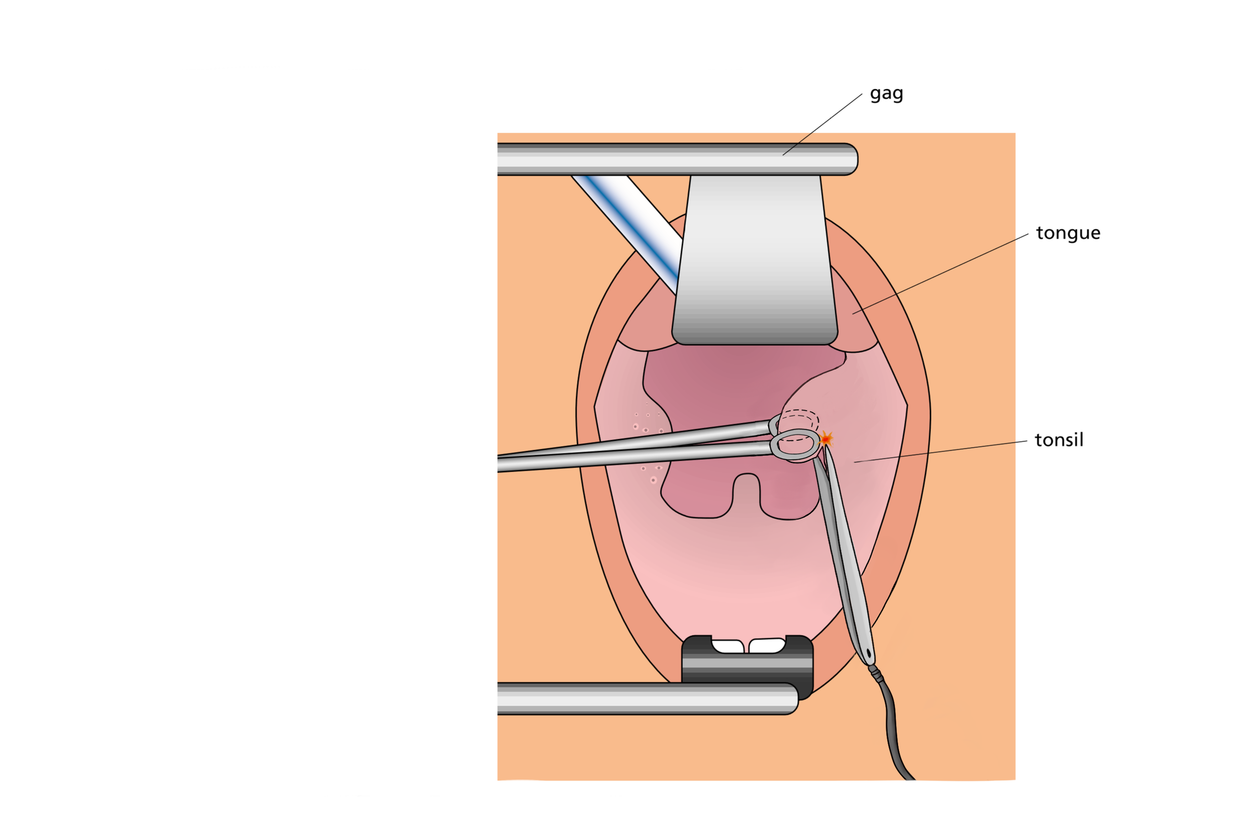 tonsil cutting.png