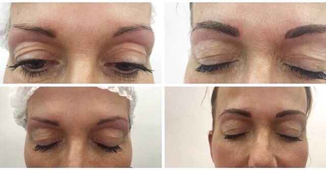 Beautiful micro-blading before and after! Book now for fuller semi-permanent brows 😍
✨
#microbladingeyebrows #microblading #microbladingstanmore