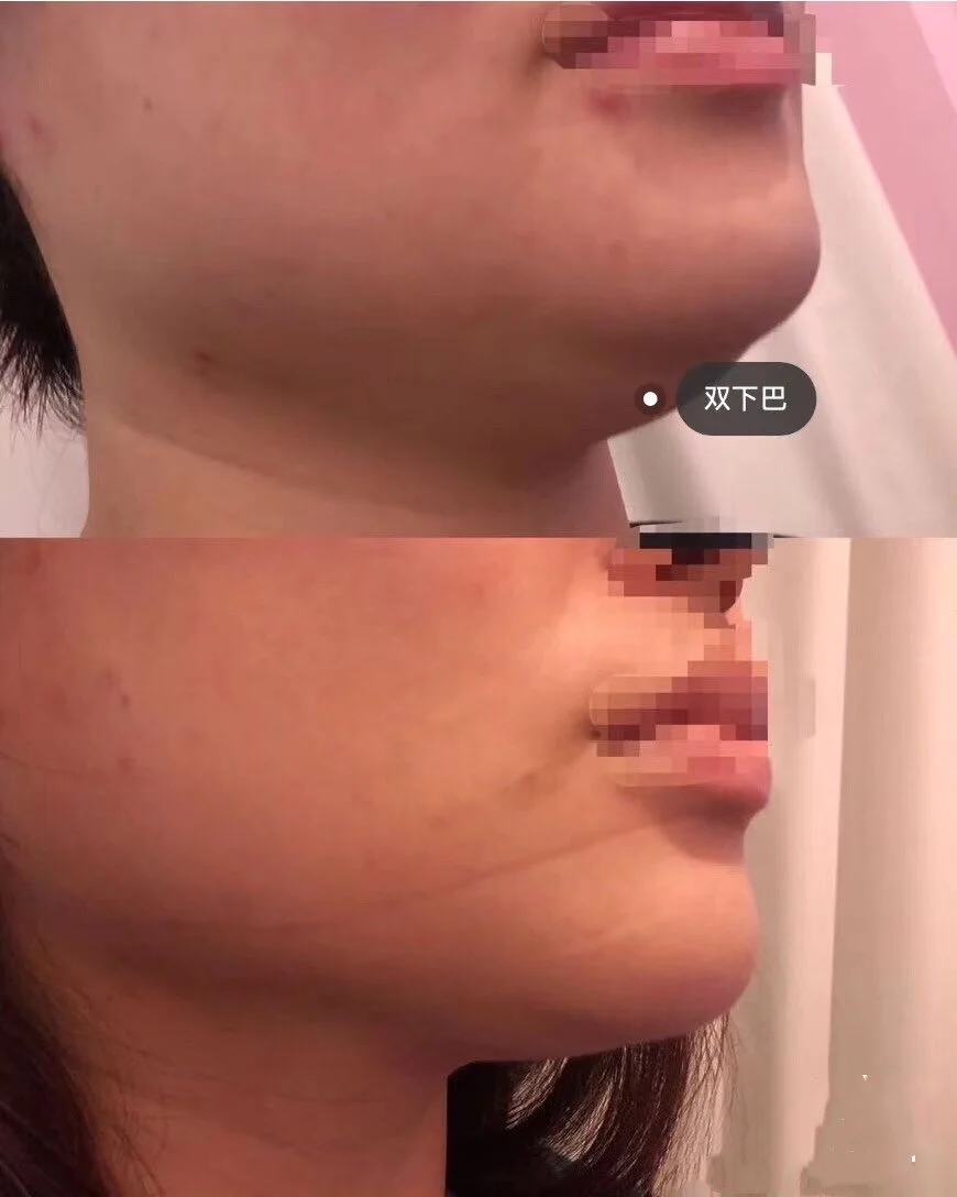 INMODE EVOKE 溶脂V臉 包包臉和雙下巴福星