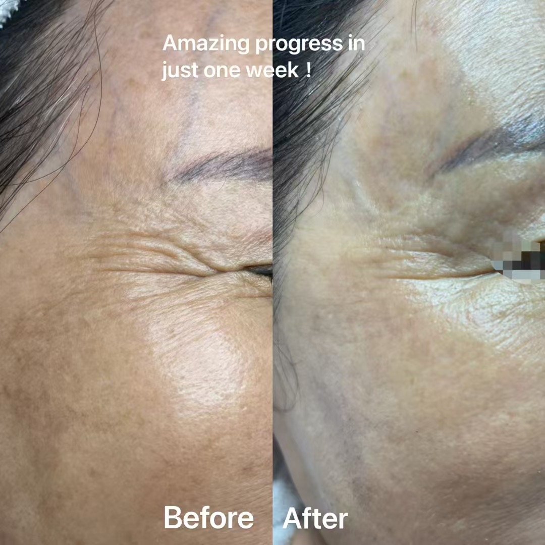 ALMA HYBRID® CO2 LASER