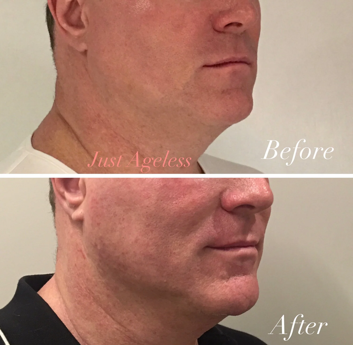Ultherapy Skin Tightening