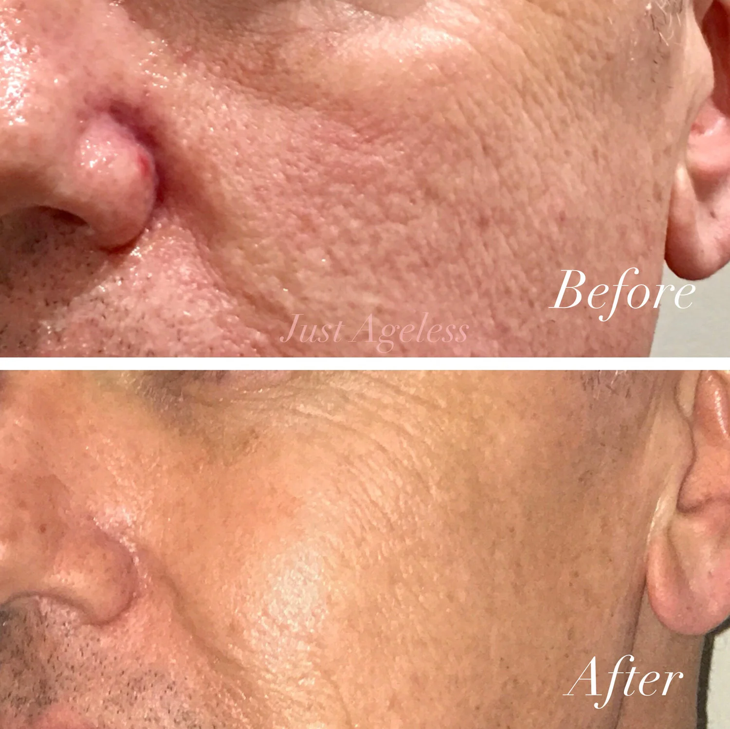 Microneedling 