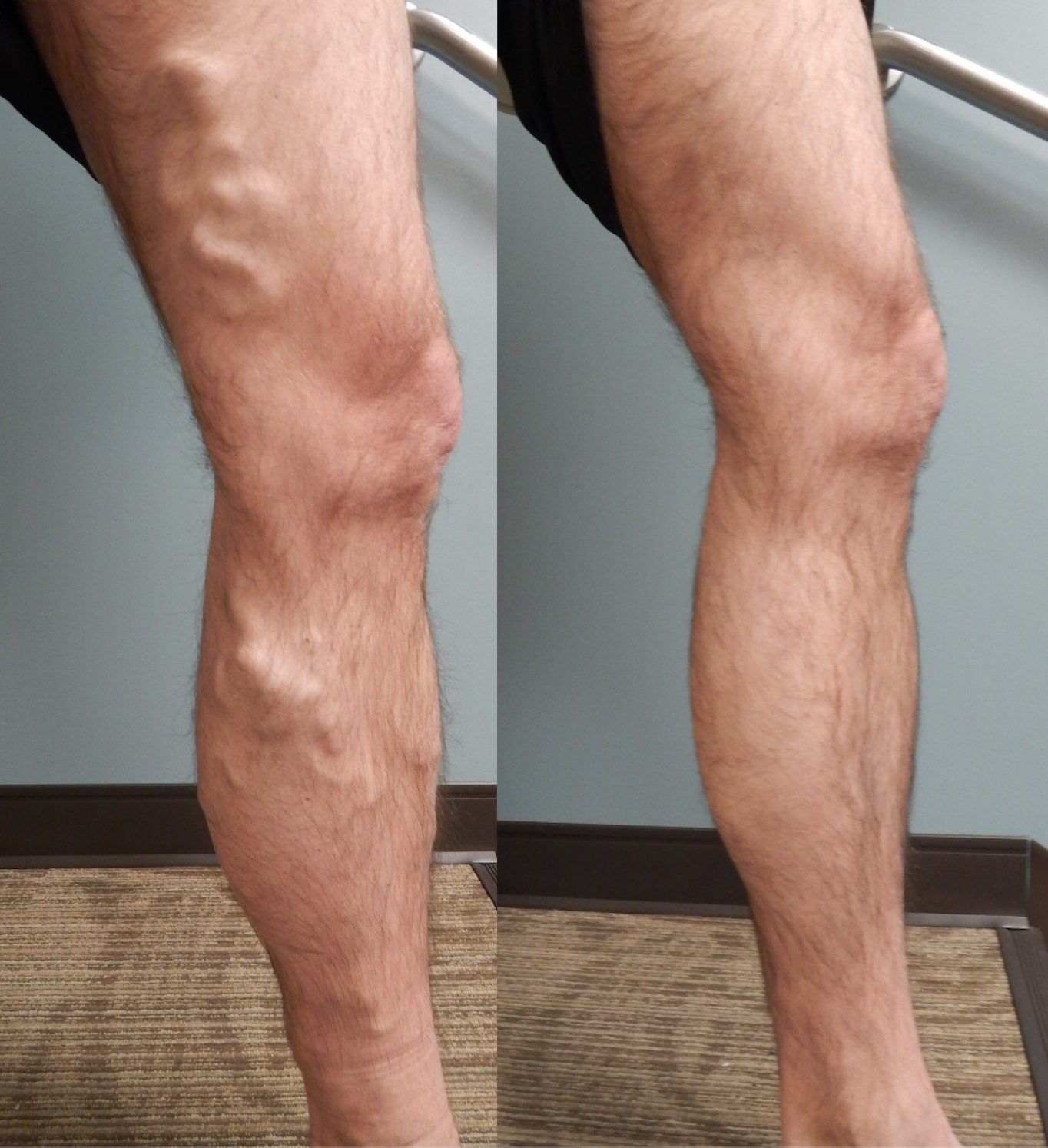 Before And After Photos Pictures Of Varicose Leg Veins Happy Patients 