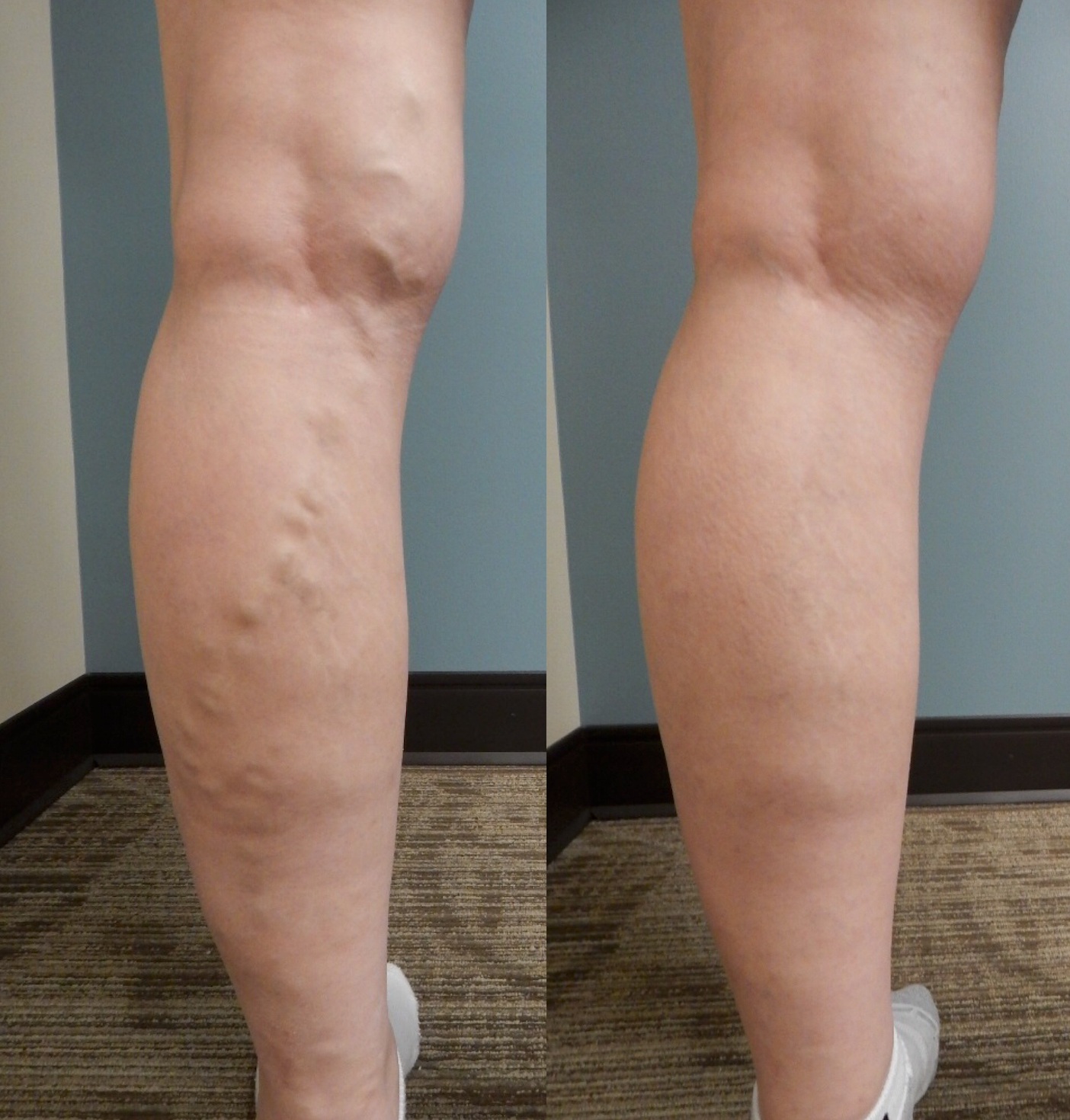 Before And After Photos Pictures of Varicose Leg Veins, Happy Patients From  Superior Vein Clinic — SUPERIOR VEIN CARE